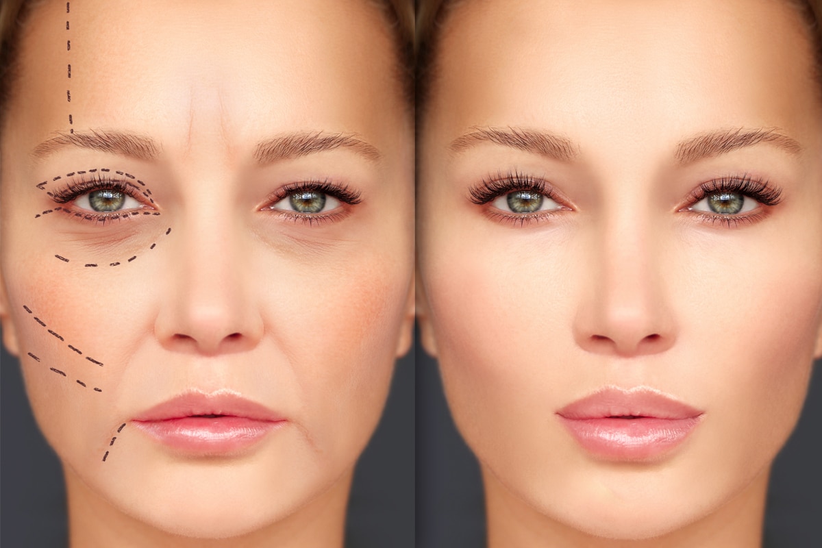 Dermal Fillers Before and After: Pictures Are Worth A Thousand