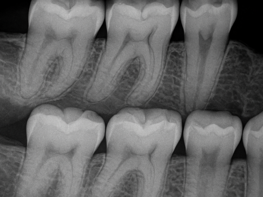Bitewing X-Rays