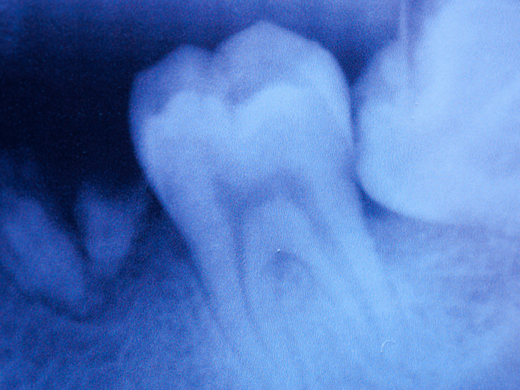 Periapical X-Rays