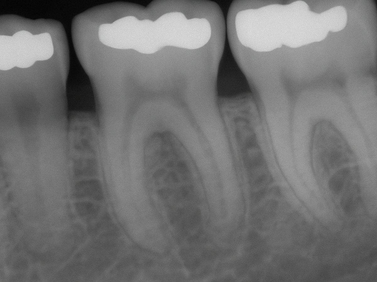 Periapical X-Rays