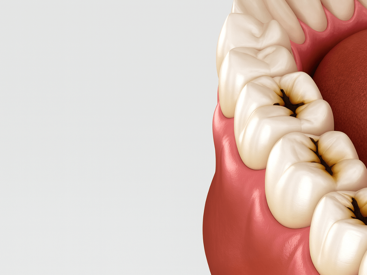 3D rendering of human lower molars with visible dental caries on the chewing surfaces, showing early signs of tooth decay and gum tissue