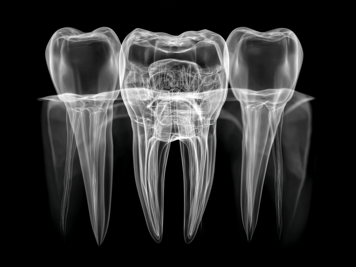 High-resolution X-ray view of human molar teeth highlighting internal structures such as roots, pulp chambers, and surrounding bone—ideal for illustrating dental anatomy or root canal context