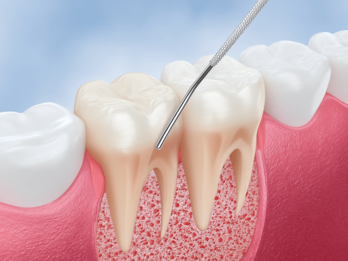 3D medical illustration of a periodontal probe inserted between the tooth and gum to measure pocket depth, showing exposed tooth roots and bone structure during gum recession check