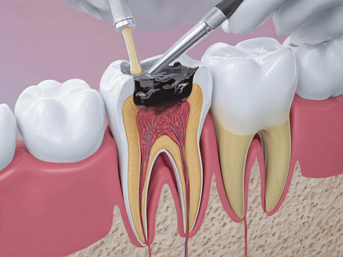Medical illustration of silver diamine fluoride being applied to a molar with a deep cavity, cross-sectional view revealing the pulp, dentin, and enamel layers, with visible instruments and gum tissue