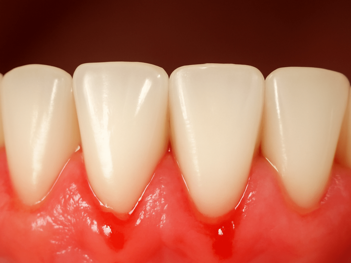 High-definition close-up of lower front teeth with mild gum bleeding and redness along the gumline, illustrating early signs of gingivitis and gum inflammation.”