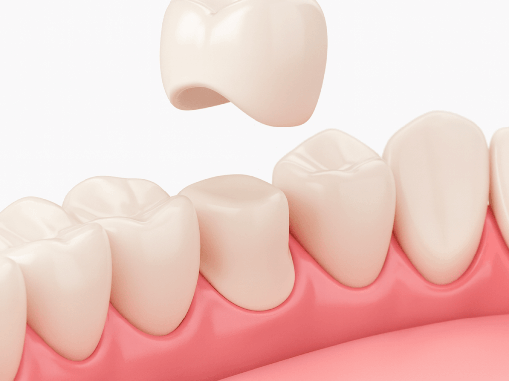 Close-up 3D illustration showing a dental crown being positioned over a prepared lower molar tooth with natural gums in a clinical view.