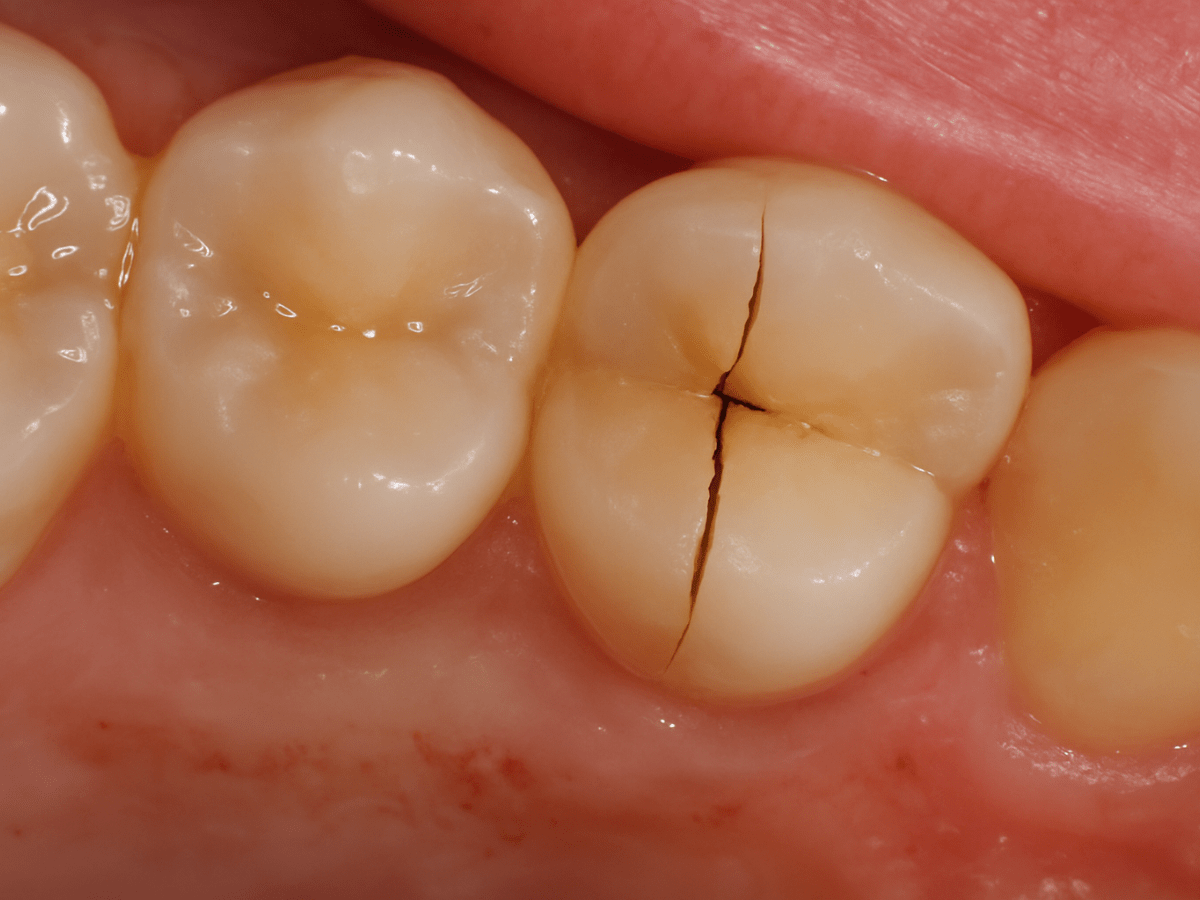 Close-up intraoral photo showing a cracked molar tooth with a prominent cross-shaped vertical fracture.
