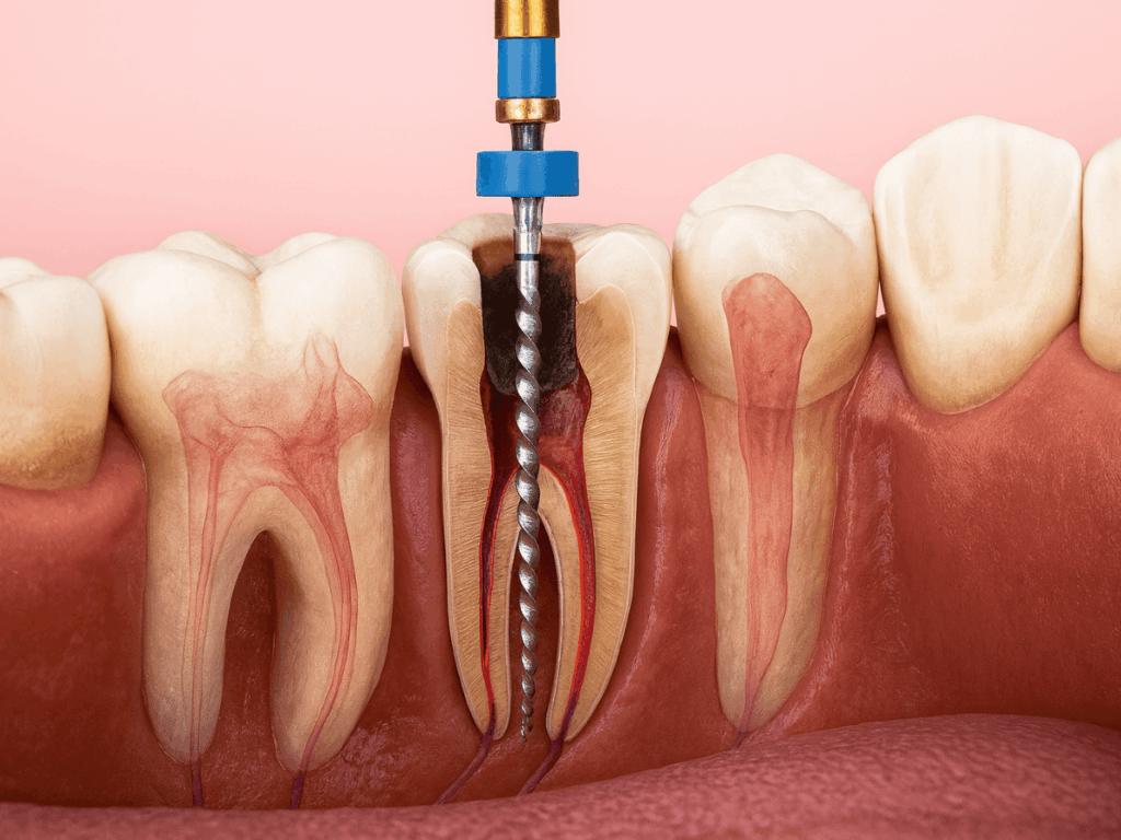 Root canal procedure on a damaged molar. Shows a dental file instrument cleaning the infected pulp inside the tooth's root canals.