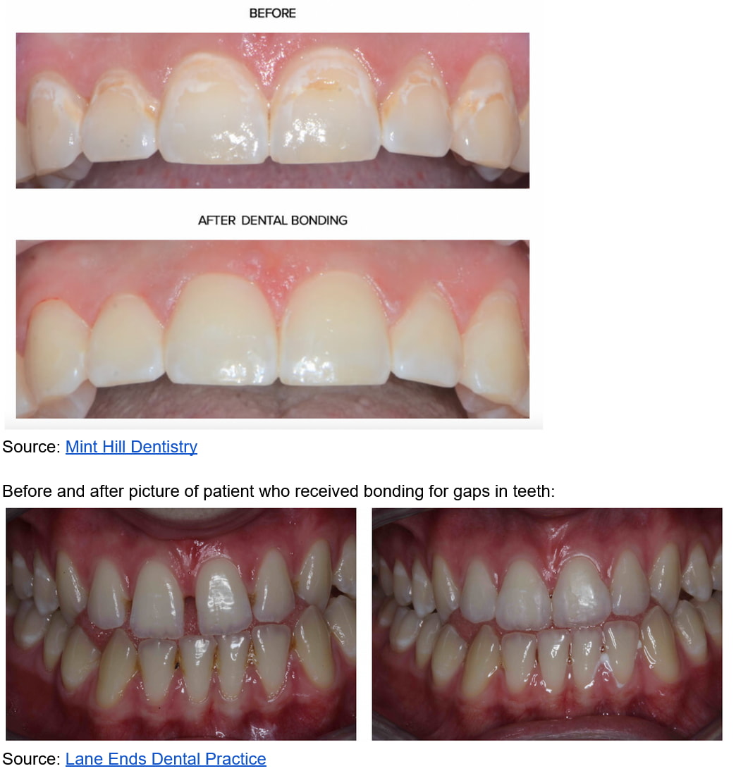 Before and after images showing the transformation of teeth with braces, highlighting improved alignment and aesthetics. 
