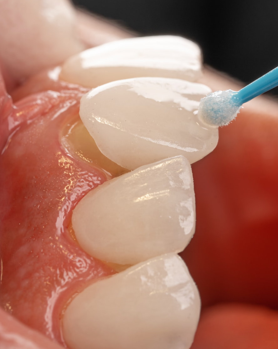 A veneer being applied to a tooth. 