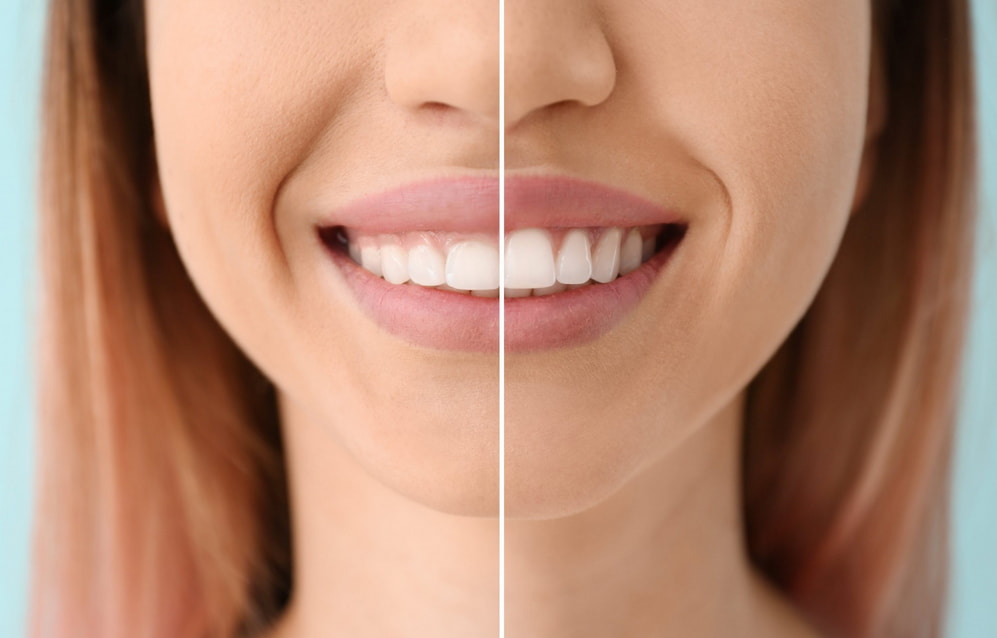 A woman shows her bright white teeth before and after a teeth whitening treatment, highlighting the dramatic improvement.
