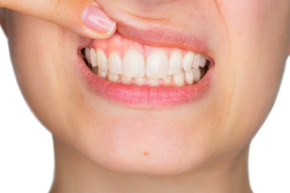 A woman with a toothbrush in her mouth, preparing to brush her teeth, with a focused expression on her face. 