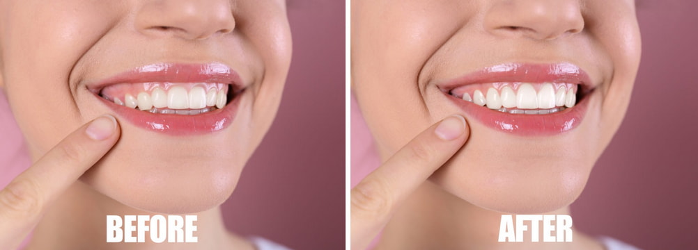 Before and after images showcasing the results of a teeth whitening treatment, highlighting significant color improvement.