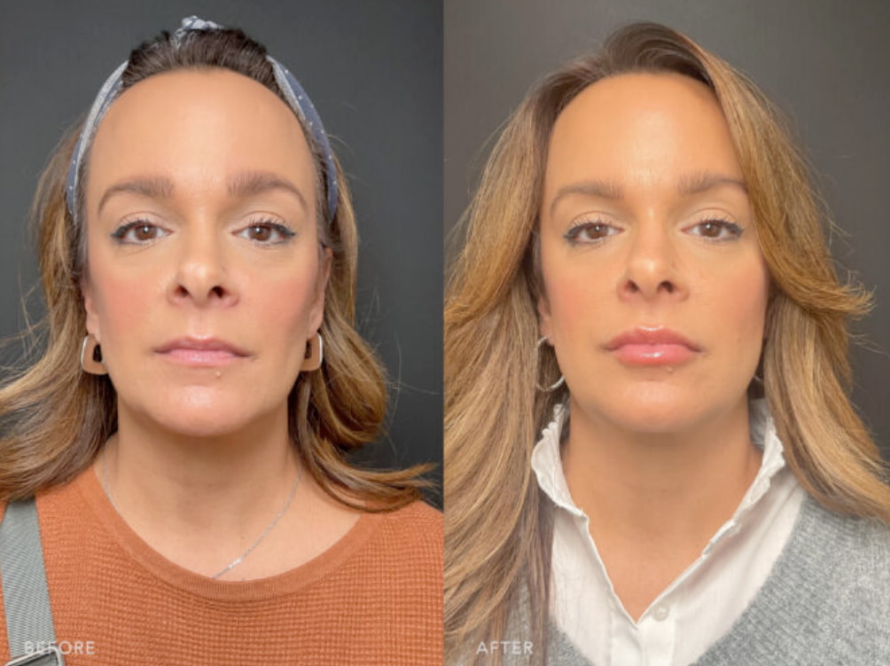 Before and after photos showing a woman's transformation following her nose job, highlighting the changes in her profile. 