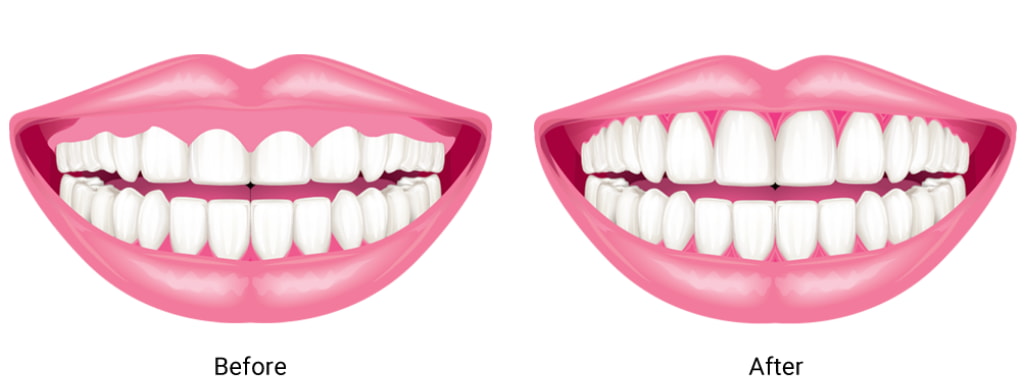 Before and after comparison of teeth whitening, showing significant improvement in brightness and color of teeth. 