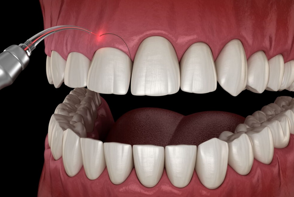 A close-up of a tooth featuring a dental implant and a laser, illustrating modern dental technology and procedures.