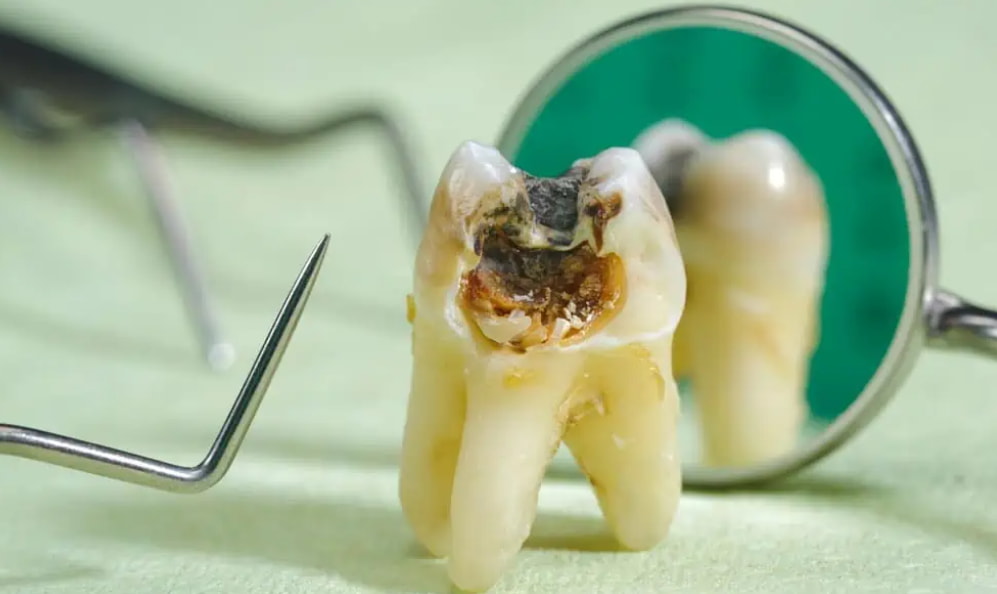 A close-up of a tooth with a hole, reflected in a mirror, highlighting dental issues and oral health concerns.