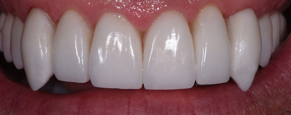 Close-up of a person's smile showcasing bright, white teeth against a neutral background. 