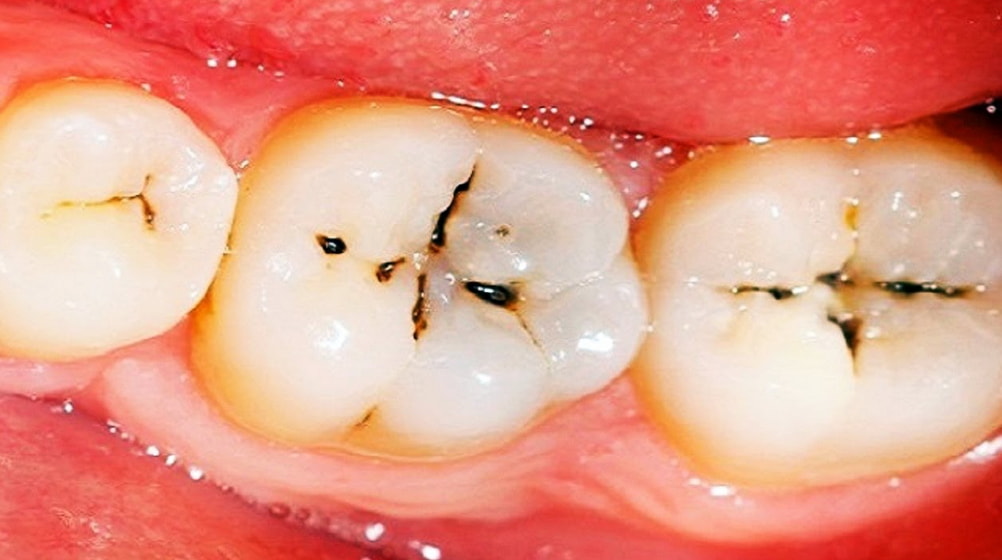 Close-up of a tooth showing a gap where a tooth is missing, highlighting dental health concerns. 