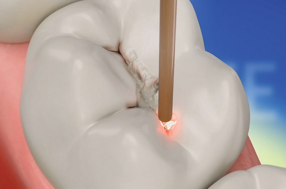 A close-up of a tooth with a toothbrush resting against it, symbolizing dental hygiene and care.