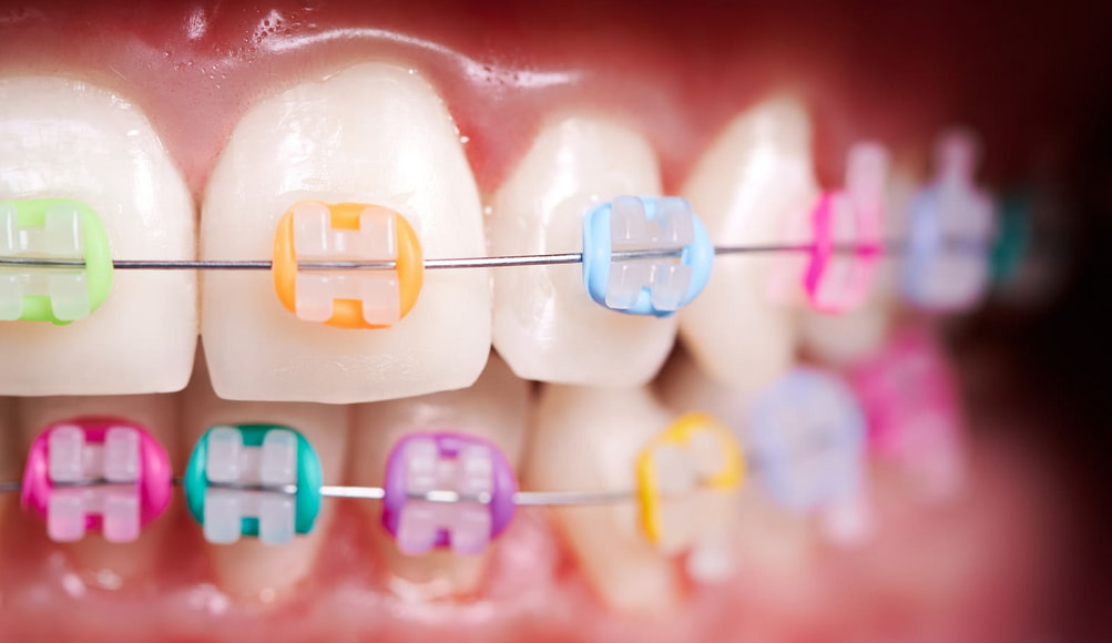 Close-up of a person's teeth showcasing metal braces, highlighting the alignment process for dental correction.