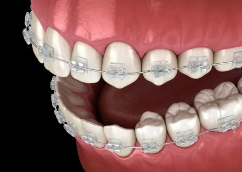 Close-up of a person's teeth showing metal braces, highlighting the alignment and dental work in progress.