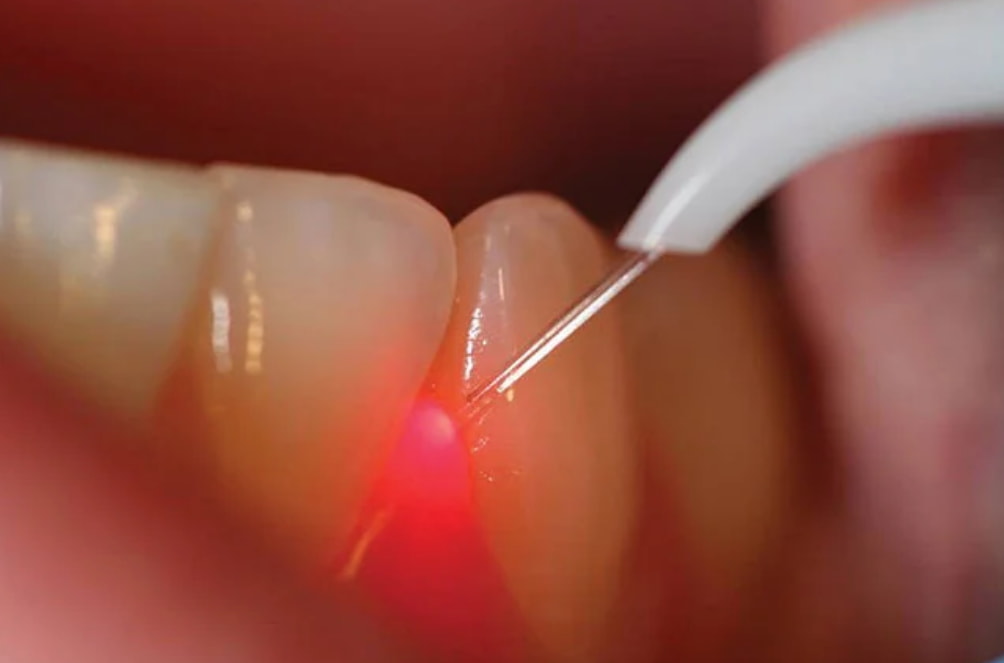 A person examines a tooth using a small red light for inspection. 