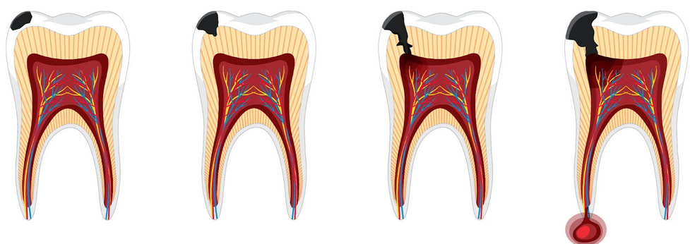 Illustration depicting the stages of tooth decay, from initial demineralization to advanced decay and potential tooth loss. 