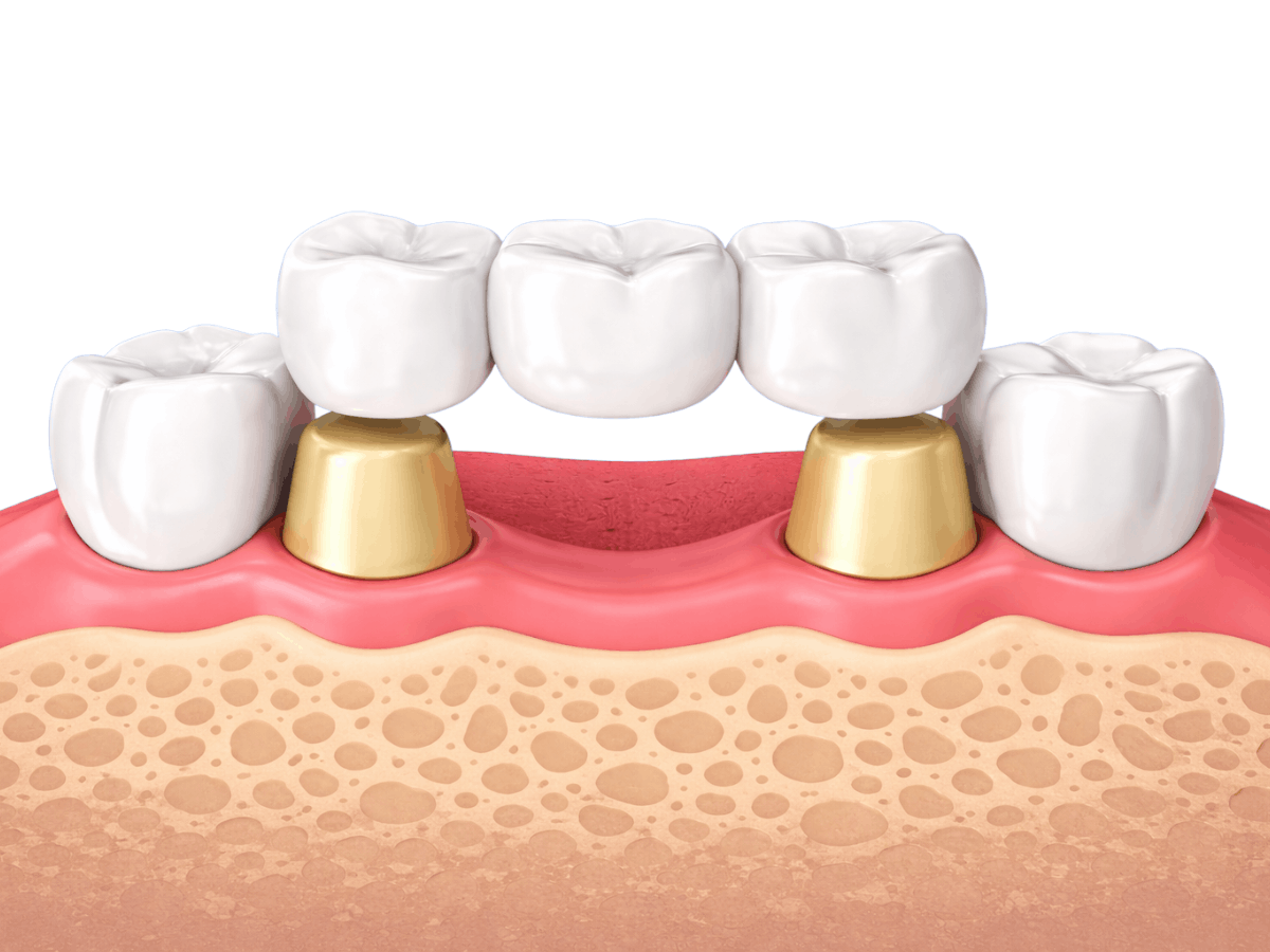 Dental bridge illustration showing a three-unit bridge supported by two crowned teeth, replacing a missing tooth in the gumline