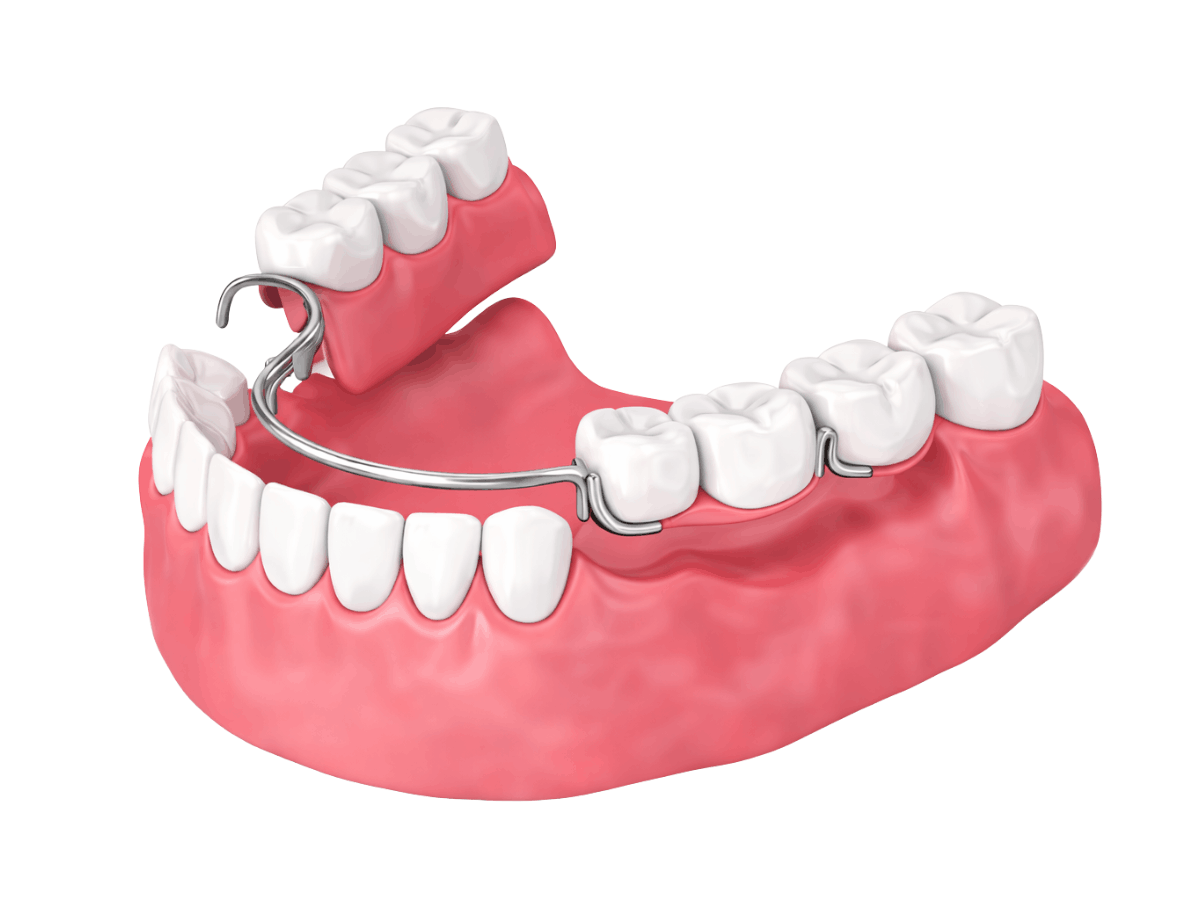 Dental illustration of a removable partial denture with a metal clasp framework replacing missing teeth on the upper jaw