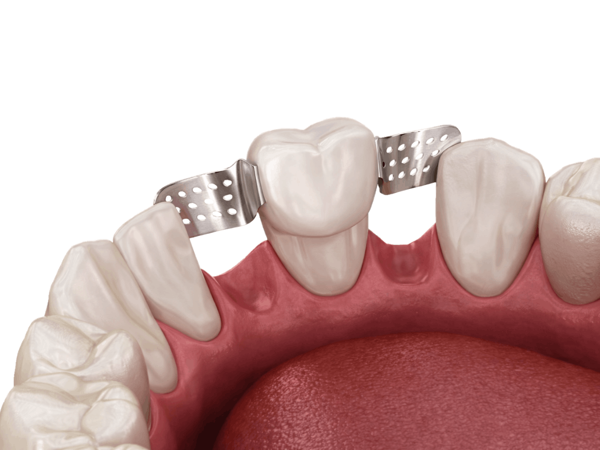 Dental illustration of a Maryland bridge showing a replacement tooth bonded to adjacent teeth with metal wings on the back surfaces