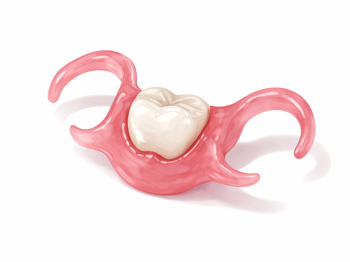 Dental illustration of a temporary flipper tooth with a single replacement tooth attached to a pink acrylic base for short-term tooth replacement