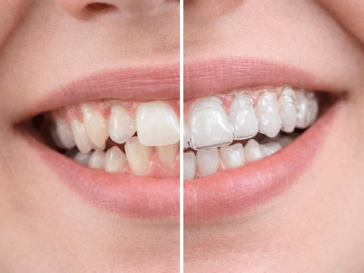 Split-screen close-up of a smile showing crooked teeth before Invisalign and straighter teeth after clear aligner treatment