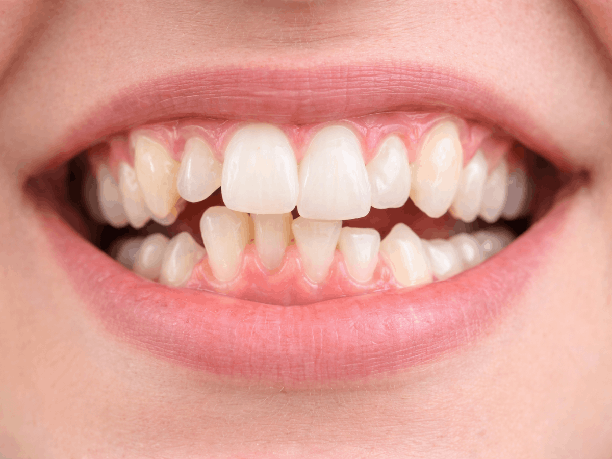 Close-up of a person smiling with mild to moderate crooked teeth and crowding, showing uneven front teeth alignment