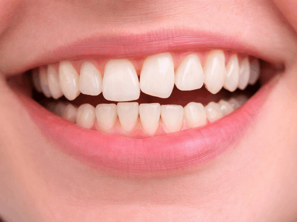Close-up of a smiling mouth showing rotated front teeth, with one tooth slightly turned out of alignment.