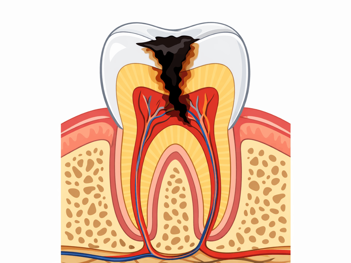 Cross-section dental illustration showing severe tooth decay penetrating enamel and dentin and reaching the tooth nerve and pulp