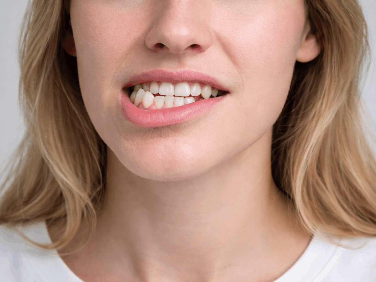 Close-up photo of a woman showing an underbite, where the lower teeth sit in front of the upper teeth due to jaw misalignment
