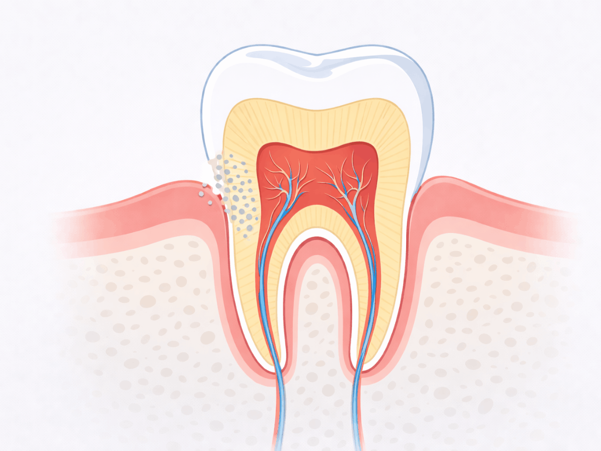 Cross-sectional illustration of a tooth showing enamel, dentin, pulp, and gum tissue, with a focus on exposed root surface and sensitivity points.