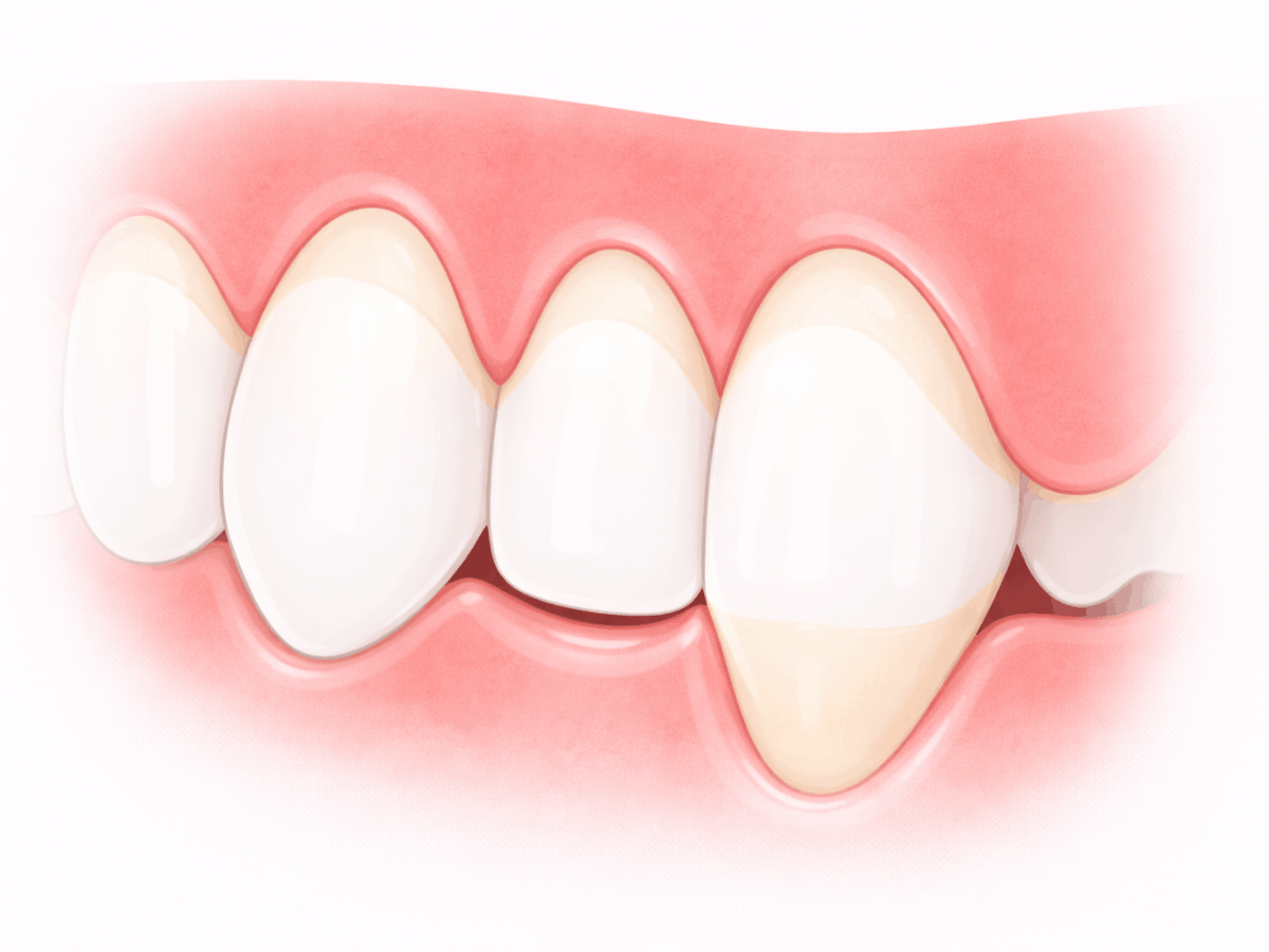 Close-up illustration of upper teeth showing receding gums with exposed tooth roots, highlighting gum recession and potential sensitivity.