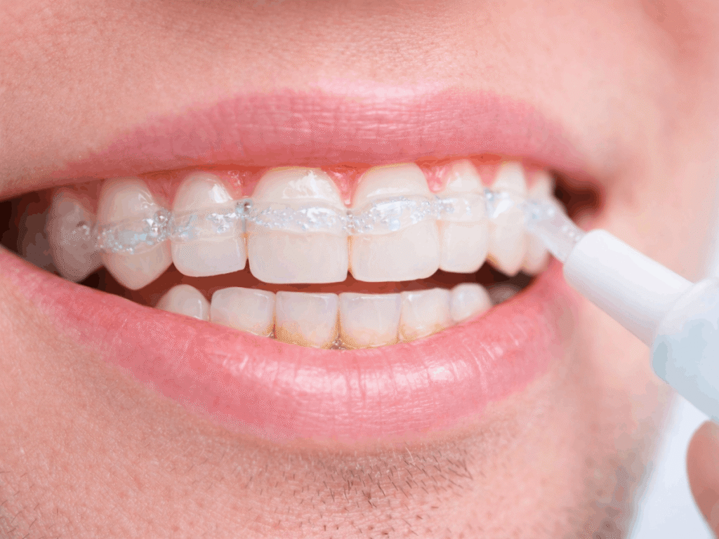 Close-up of a person applying teeth whitening gel into a clear aligner tray before placing it over upper teeth for at-home whitening treatment.