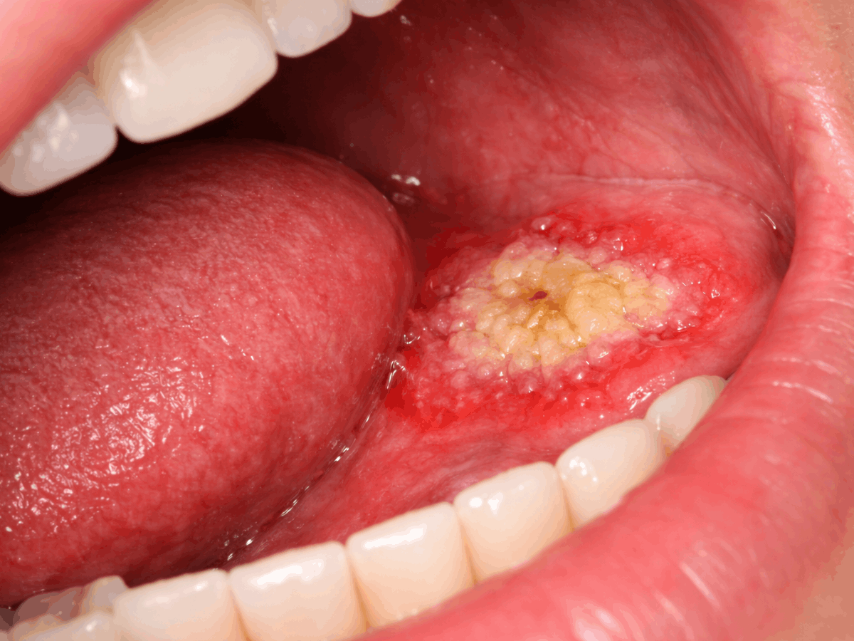 Close-up of an oral ulcer on the side of the tongue with inflamed red tissue and a yellowish center.