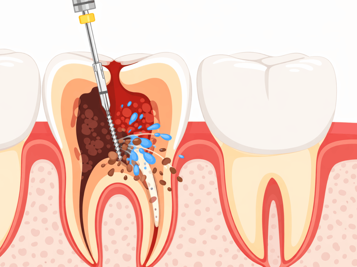 Dental illustration showing a root canal file cleaning and flushing bacteria from inside an infected tooth canal.