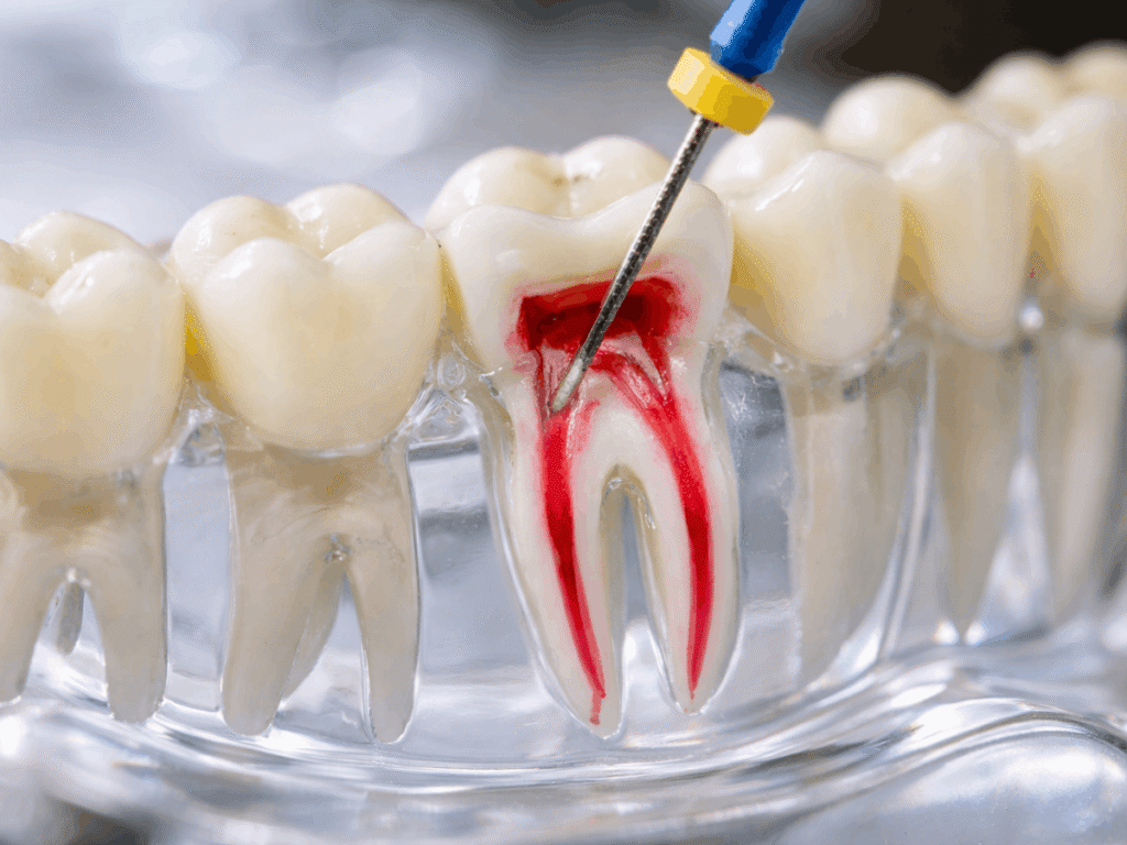 Dental illustration showing a root canal procedure with an endodontic file cleaning infected pulp inside a tooth.