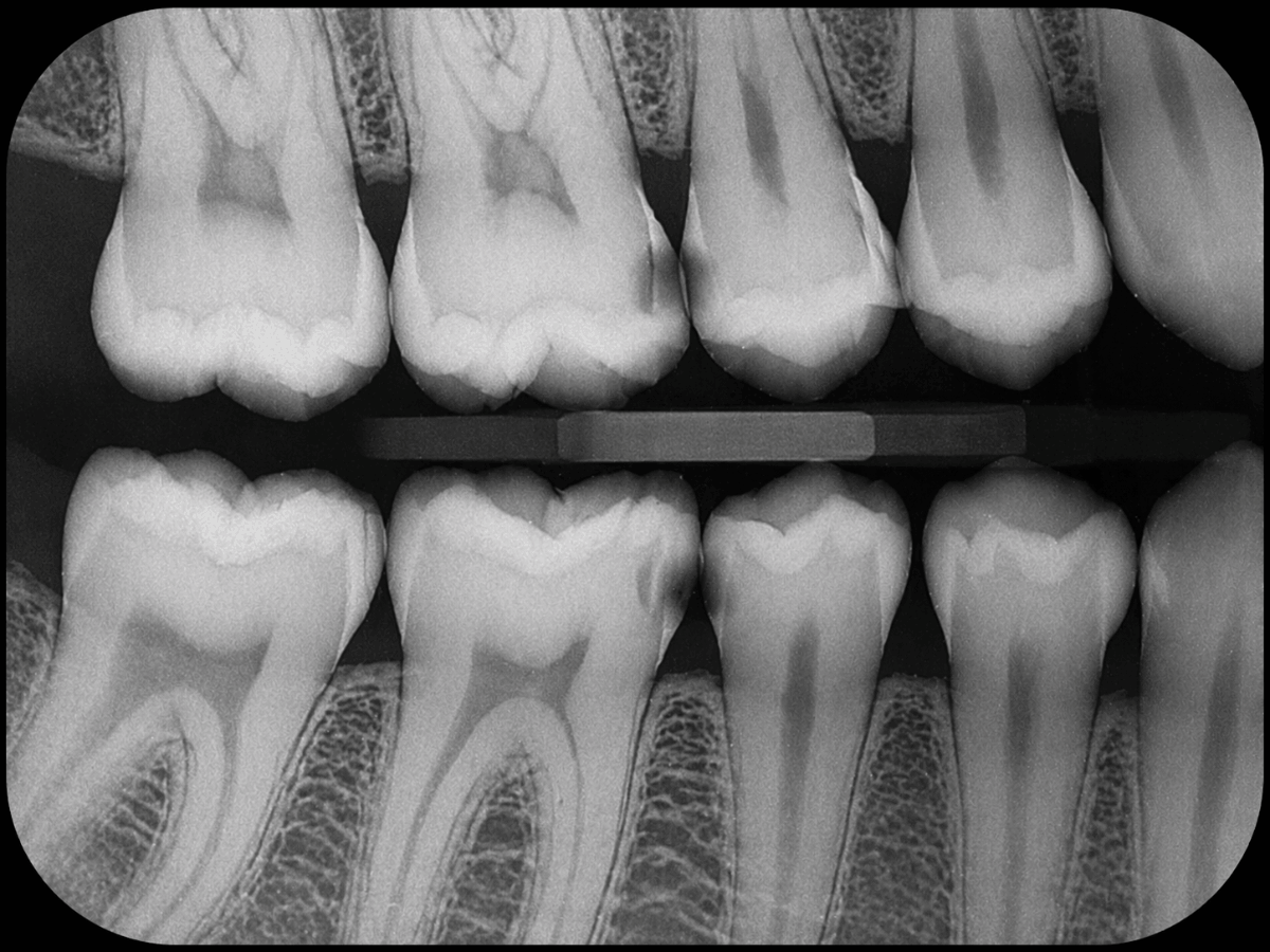 Digital dental X-ray showing early demineralization and decay between teeth beneath the enamel surface