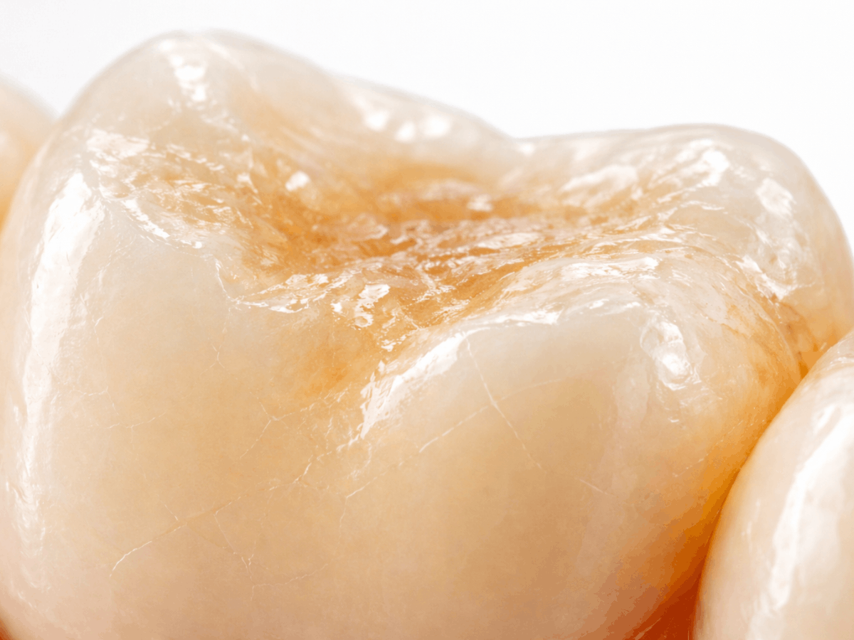 human molar showing deteriorated tooth enamel with visible surface erosion, micro-cracks, and amber discoloration, demonstrating why damaged enamel cannot be reversed by oil pulling for cavities