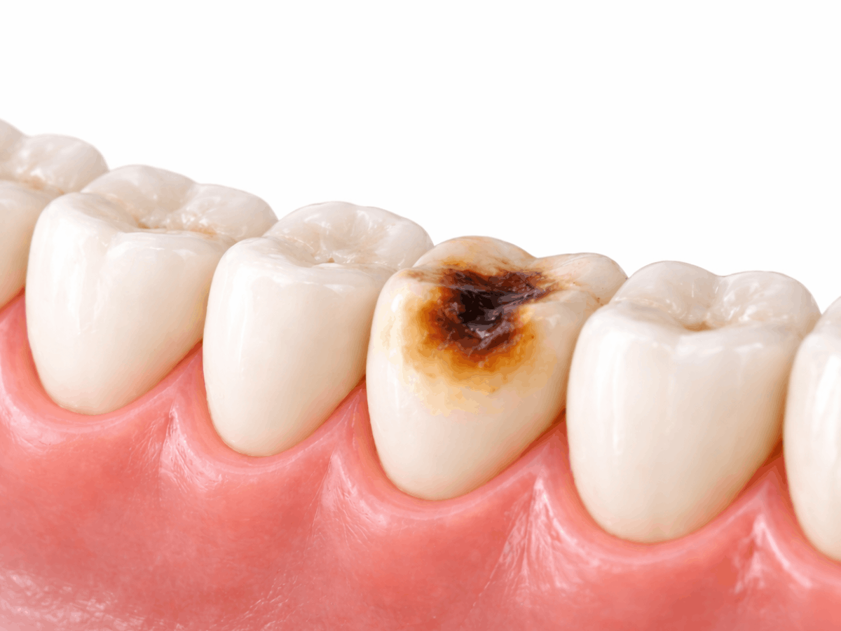 dental model showing a tooth with visible cavity and brown decay surrounded by healthy white teeth and pink gum tissue, illustrating why oil pulling for cavities cannot reverse structural tooth damage