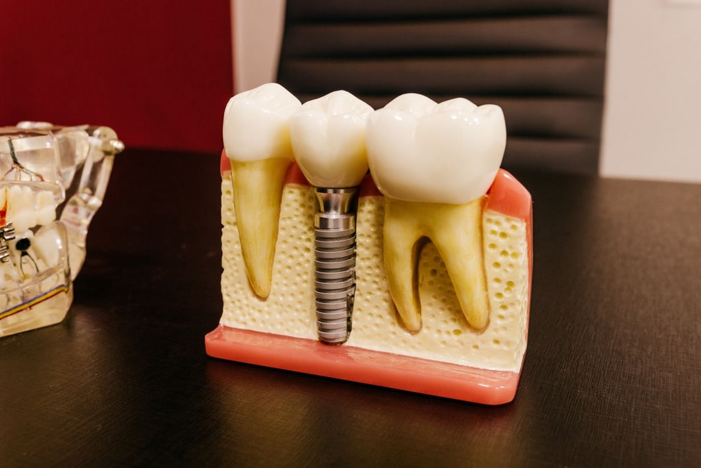 Dental model showing teeth and implant on a black table, illustrating oral health and prosthetic dentistry concepts.