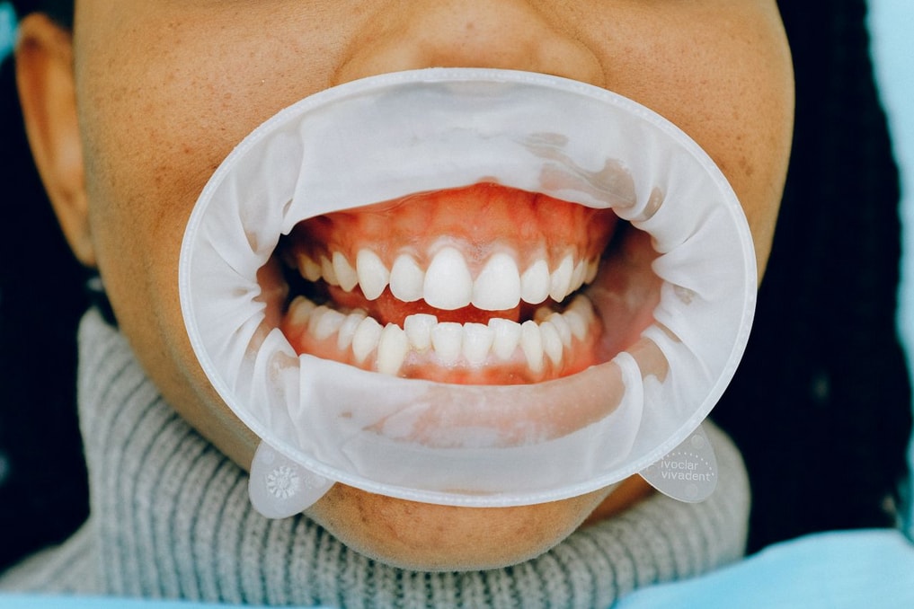 Close-up of a person using a dental cheek retractor, revealing clean, aligned teeth and gums during a dental examination.